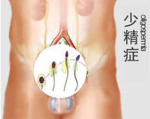 少精症