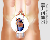 睾丸附睾炎