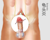 龟头炎