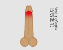 尿道畸形